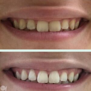 Clareamento Dental em Mogi das Cruzes