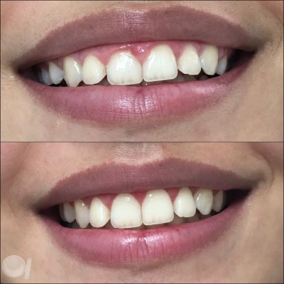 Gengivoplastia para um sorriso mais bonito