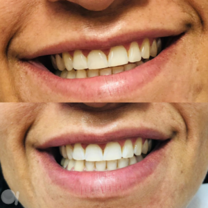 Clareamento Dental em Mogi das Cruzes