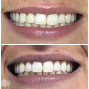 Clareamento Dental em Mogi das Cruzes