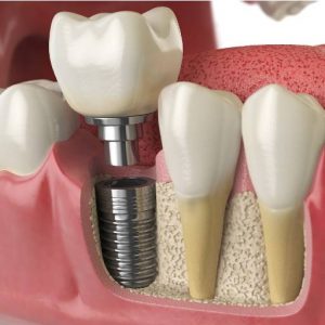 Implante Dentário em Mogi das Cruzes