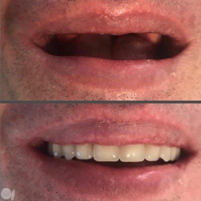 Implante dentário em Mogi das Cruzes